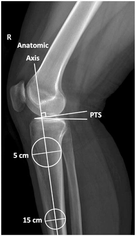 The Relationship Between Posterior Tibial Slope And Pediatric Tibial