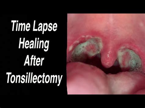 Uvula After Tonsillectomy