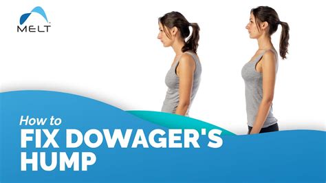 How To Fix Dowagers Hump On Your Upper Back And Neck Melt Method