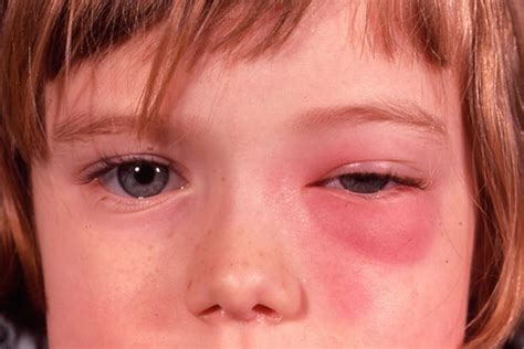 Eye Infections In Baby Children And Adults Causes Diagnosis And Treatment