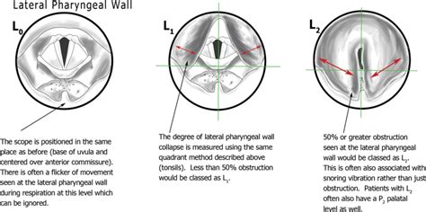 Lateral Pharyngeal Wall With Explanations Download Scientific Diagram