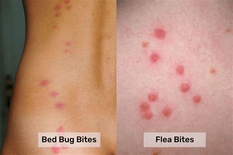 Bed Bugs Bite Vs Flea Bite Whats The Difference Pest Control Gurus
