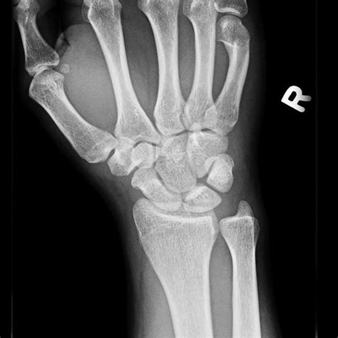 Scaphoid Fracture Radiology Case