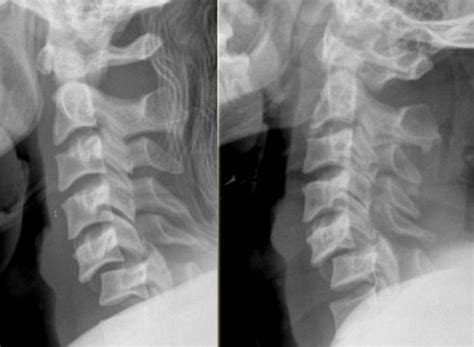 Cervical Facet Dislocations And Fractures Spine Orthobullets