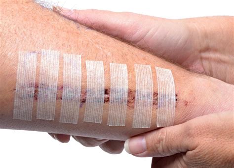 How To Make Dissolvable Stitches Dissolve Quicker