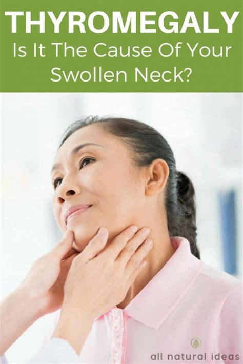 Thyromegaly Is It The Cause Of Your Swollen Neck All Natural Ideas