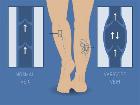Useful Facts You Should Know About Varicose Veins