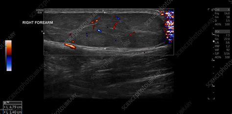 Multiple Lipomas Ultrasound Scan Stock Image C0549658 Science