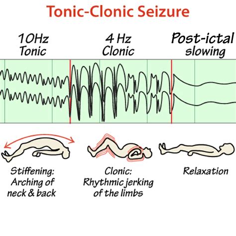 Tonic Clonic Seizure Neurological System Flashcards Ditki Medical