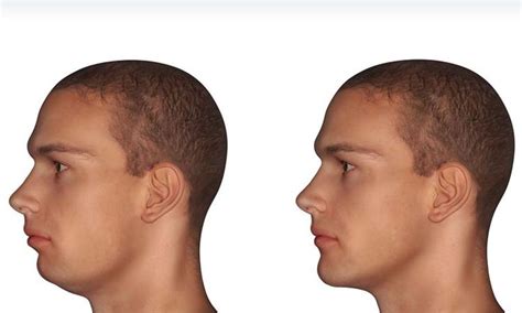Weak Chin Causes Effects Improvements Chin Augmentation Weak