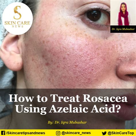 How To Treat Rosacea Using Azelaic Acid Skincare News