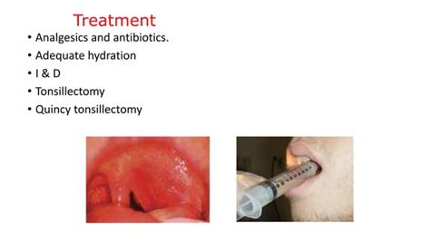 Tonsillitis Quinsy And Adenoiditis Ppt