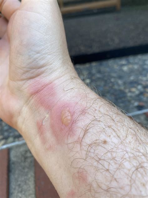 Any idea if this is a spider bite or something else? : spiderbites