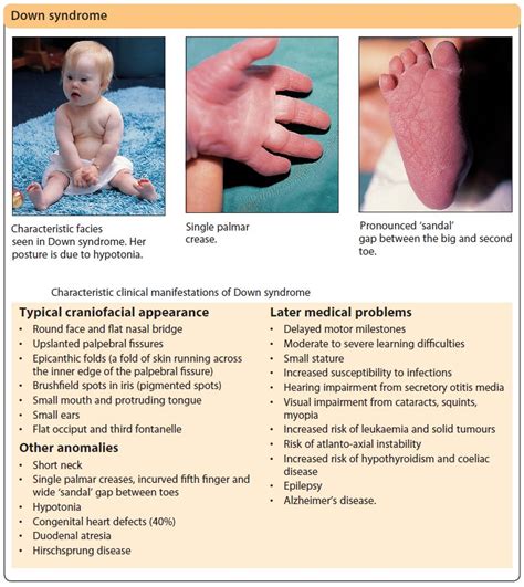 Characteristic Clinical Manifestations Of Down Syndrome Grepmed