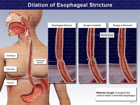 Dilation Of Esophageal Structure TrialExhibits Inc