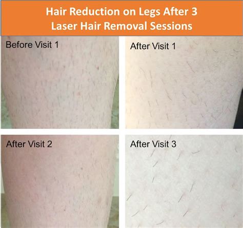 Follow My Laser Hair Removal Experience Legs Brazilian And Random