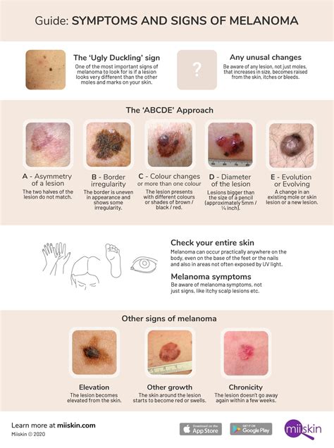What Are The Signs And Symptoms Of Melanoma Skin Cancer Know Sign