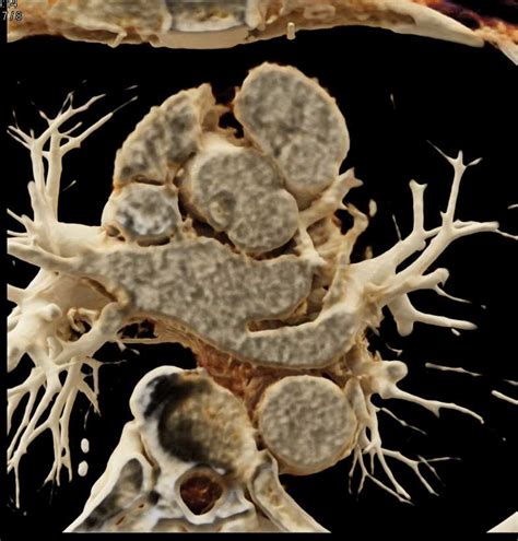 Papillary Fibroelastoma Off The Aortic Valve Cardiac Case Studies