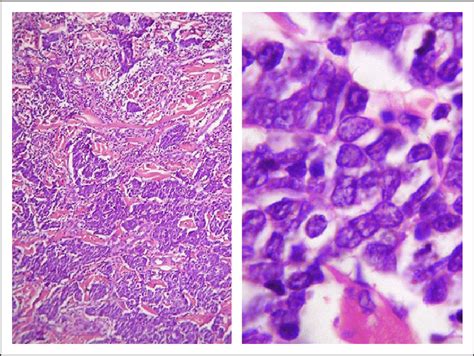 Cancer occurs when cells begin to randomly divide and grow out of control. Pathology of Merkel cell carcinoma: proliferation of ...