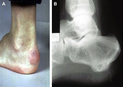 The Treatment Of Calcaneal Malunion Foot And Ankle Clinics