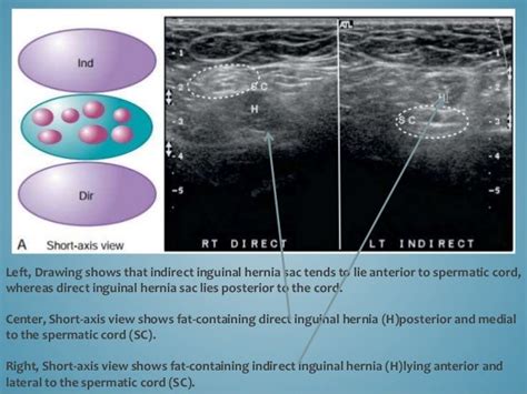 Ultrasoud Hernia