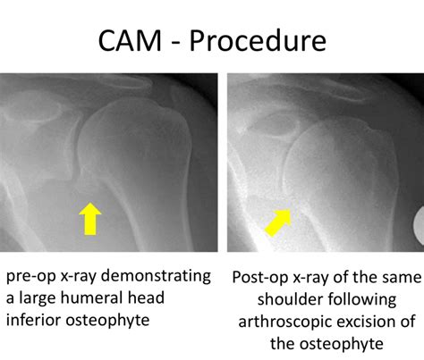 Fig 5 Cam Procedure Osteophyte Resection Cambridge Shoulder