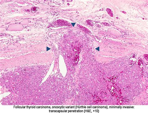 Pathology Outlines Oncocytic Hürthle Cell Tumors