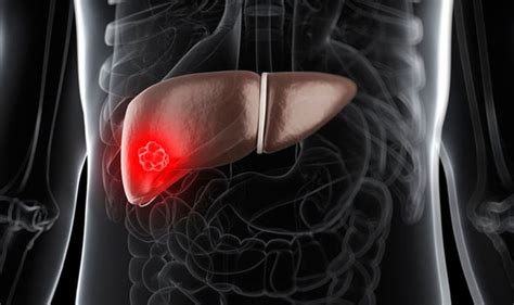 Liver cancer presents a special challenge because you may not notice any symptoms when the disease is starting and in its early stages. Liver cancer symptoms: Stomach pain and vomiting are signs ...