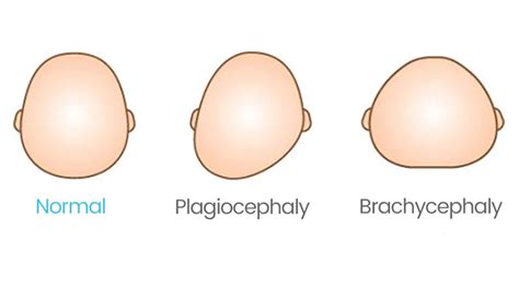 Positional Flat Head Syndrome Also Known As Plagiocephaly — Why Motor