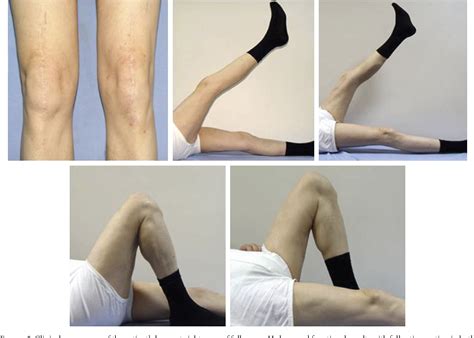 Pdf Simultaneous Bilateral Quadriceps Tendon Rupture In A Patient With Diffuse Idiopathic