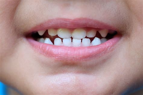 Treatments Used For Enamel Hypoplasia Of Milk Teeth Catsup And Mustard