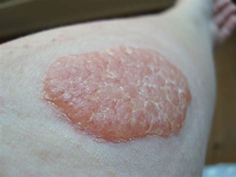 The reaction is likely to get complicated and this would call for an alternative remedy. Allergic to Hair Dye Skin Test, Black Henna Tattoo, Dyed ...