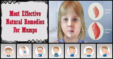 Most Effective Home Remedies For Mumps Dr Farrah Md