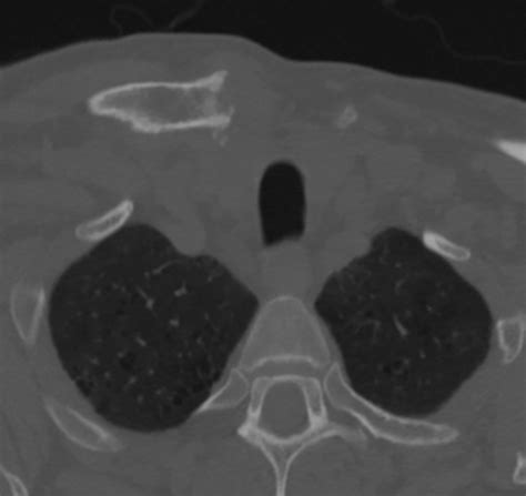 Postoperative Ct Showing Excision Of The Posterior Osteophyte From The