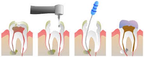 How much does root canal cost? How Much does a Root Canal Cost? | New Health Guide