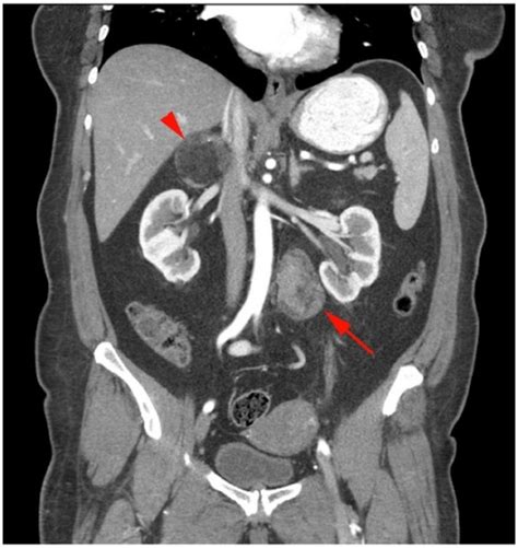 Retroperitoneal Hematoma Coronal Image Of Ct Of The Abdomen Shows My
