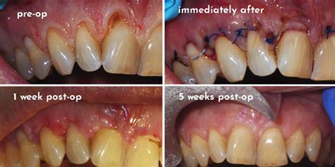 Gingival Graft