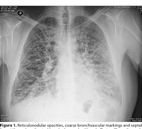 Figure 1 From Pulmonary Lymphangitic Carcinomatosis In The Course Of