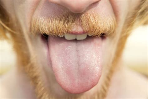 They can also be the sign of a serious condition such as oral cancer. Large, White Bumps on the Tongue | Livestrong.com