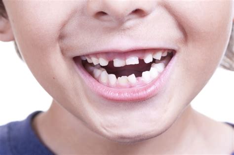 Orthodontic Issues Caused By Thumb Sucking Dunn Orthodontics