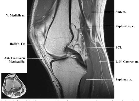 Figure From Normal Mr Imaging Anatomy Of The Knee Semantic Scholar
