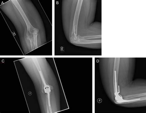 Results Of Cementless Total Elbow Arthroplasty Using The Discovery
