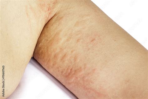 Allergic Rash Skin Of Patient Arm Stock Photo Adobe Stock