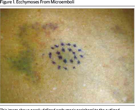 Figure 1 From Hemorrhagic Panniculitis Caused By Delayed Microemboli