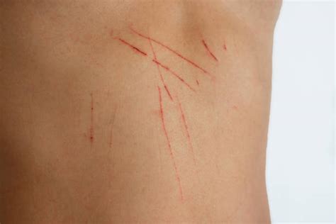 Texture Of Human Skin And Scratch Stock Image Colourbox