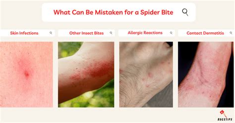 Should You Squeeze The Pus Out Of A Spider Bite Bugstips
