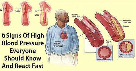 6 Signs That Could Mean You Have High Blood Pressure