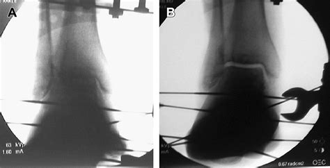 Ankle Joint Distraction Arthroplasty Foot And Ankle Clinics