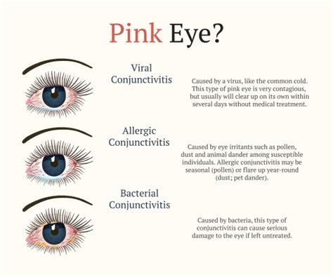 Conjunctivitis Altoona Pink Eye Brookville Laurel Eye Clinic Dubois