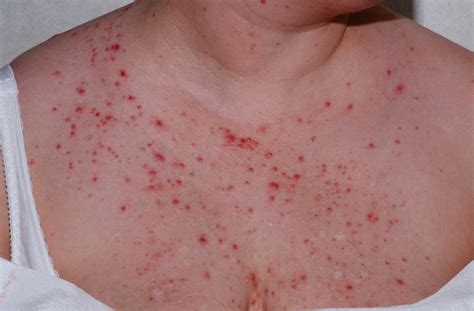 Is It Acne Or Malassezia Folliculitis The Devil Is In The Details